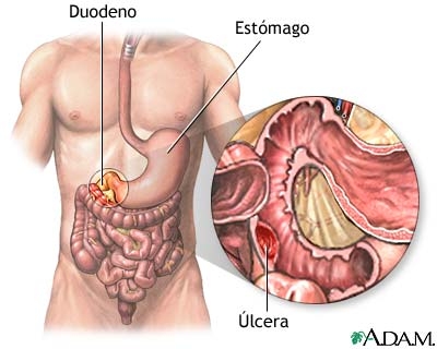 Hemoragiile gastrointestinale